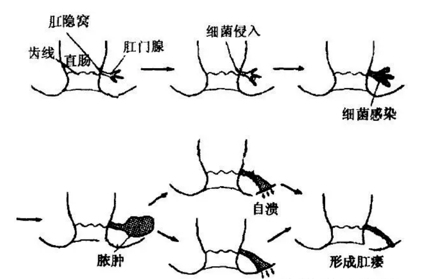 肛门直肠周围脓肿图片