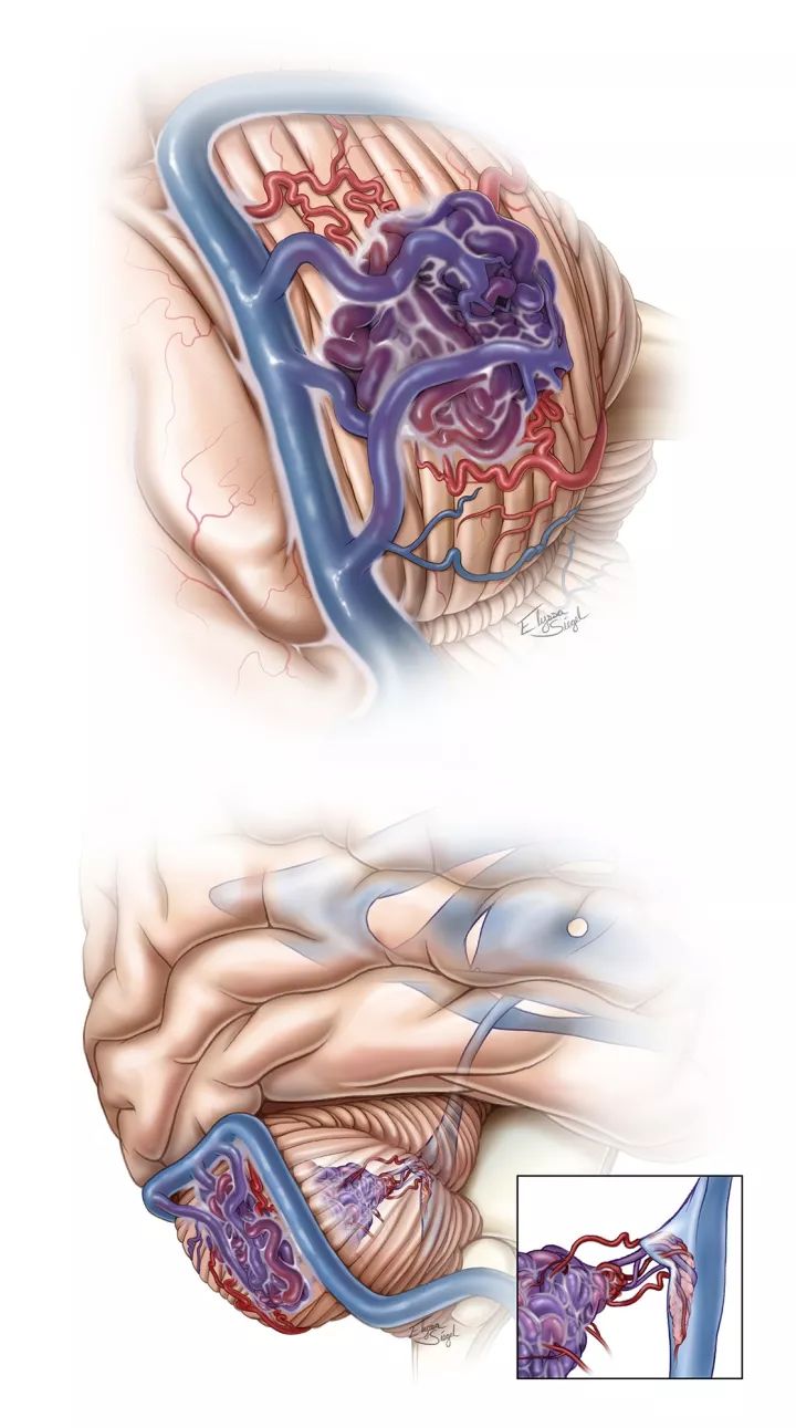 小脑蚓部血管畸形图片