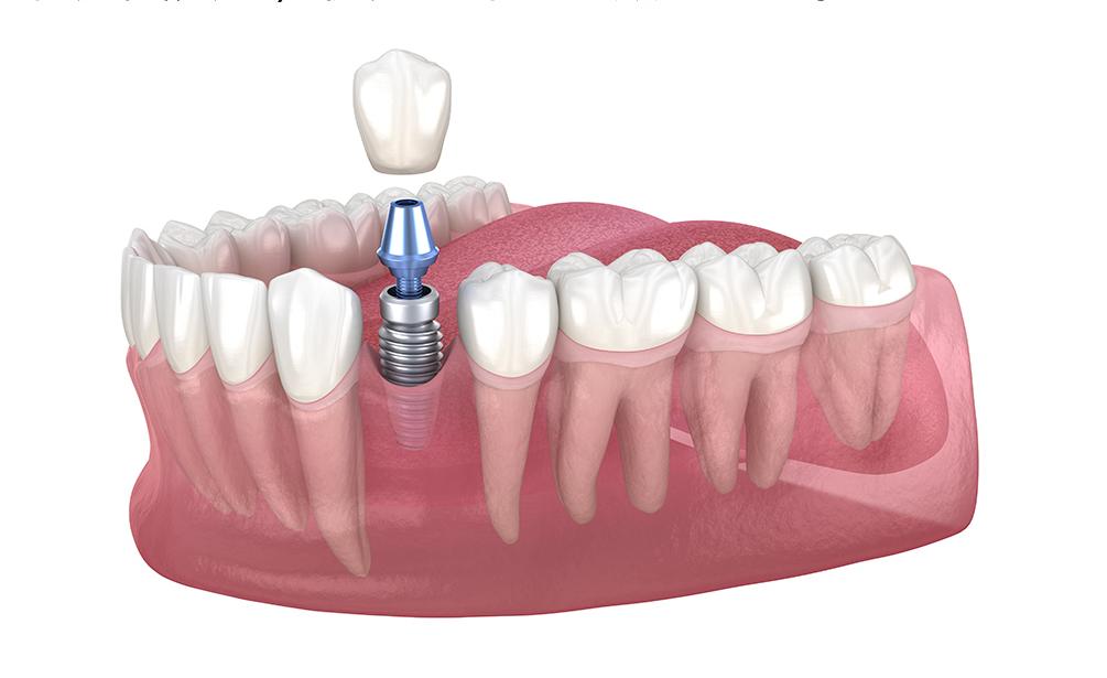 稳固耐用瑞士 iti 种植牙和咱们的骨头相容性特别好,就像自己的