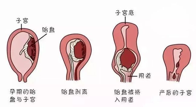 浆液性恶露图片