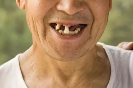 75岁以上老年人缺牙怎么办?镶牙种牙选不对,后患无穷!