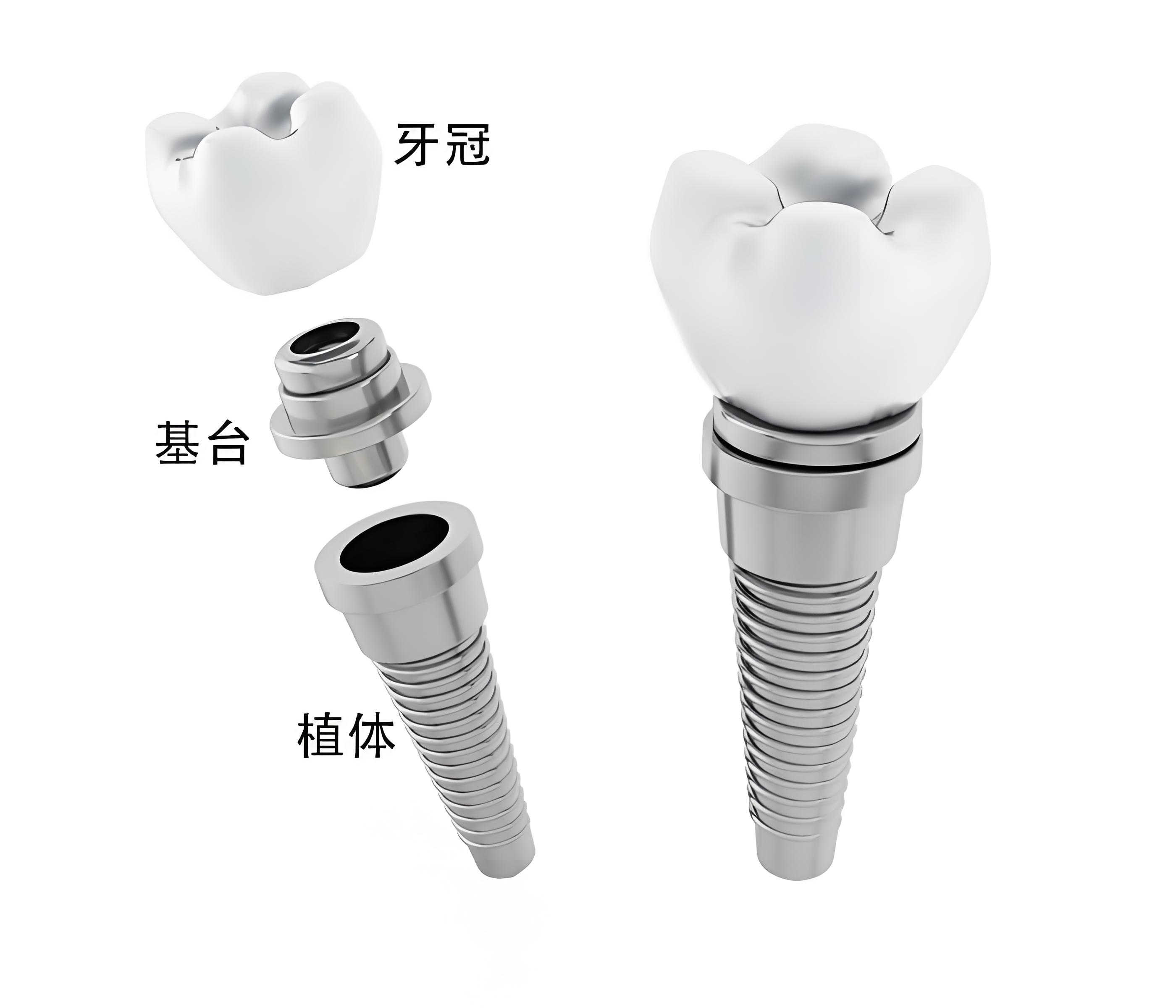种植愈合基台的作用是什么?一般用多久才能换永久基台?