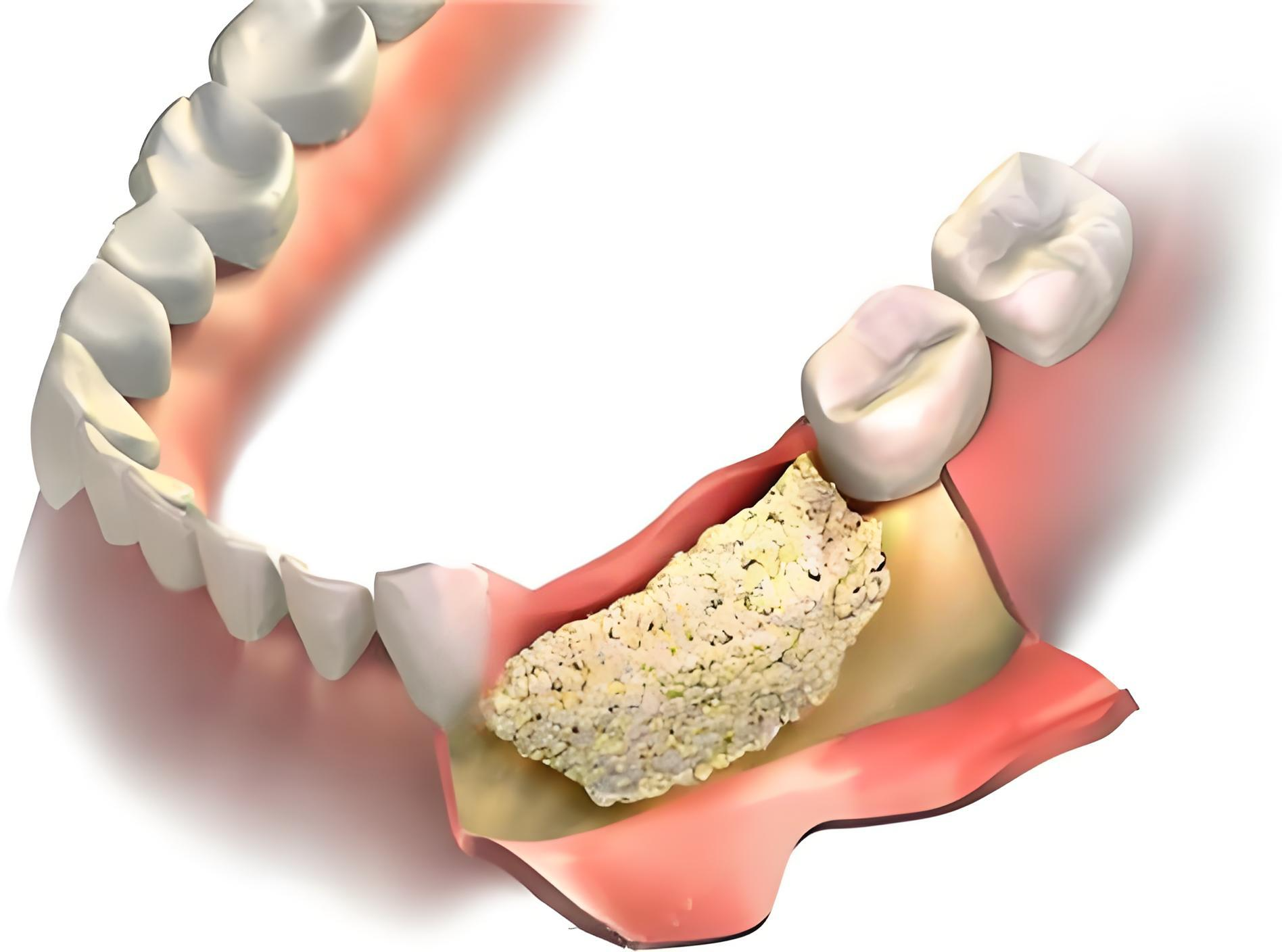 会不会疼呢?种植牙为什么要填骨粉?适合种植牙的槽骨高度