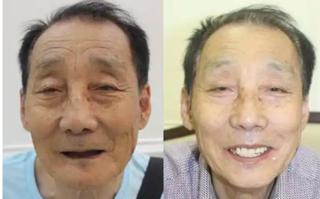 老年人种牙风险大吗?揭秘老人种牙适应症,禁忌症及替代方案对比