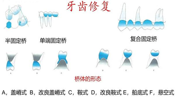 半口种植牙什么意思