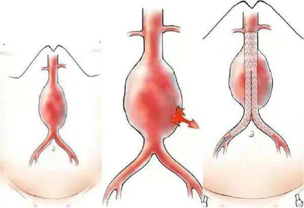 动脉瘤症状图片