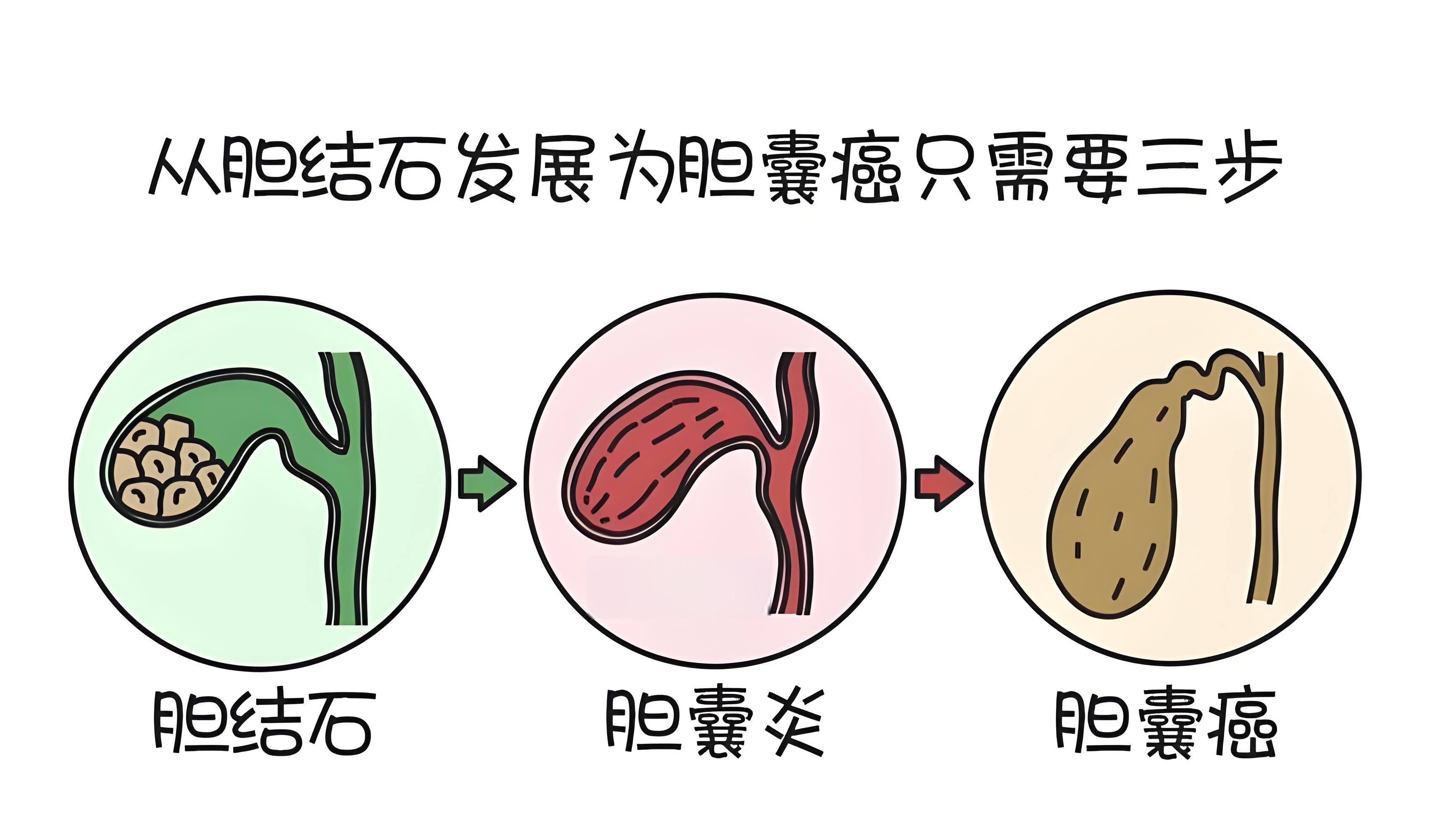 胆囊炎 早期症状与预防策略