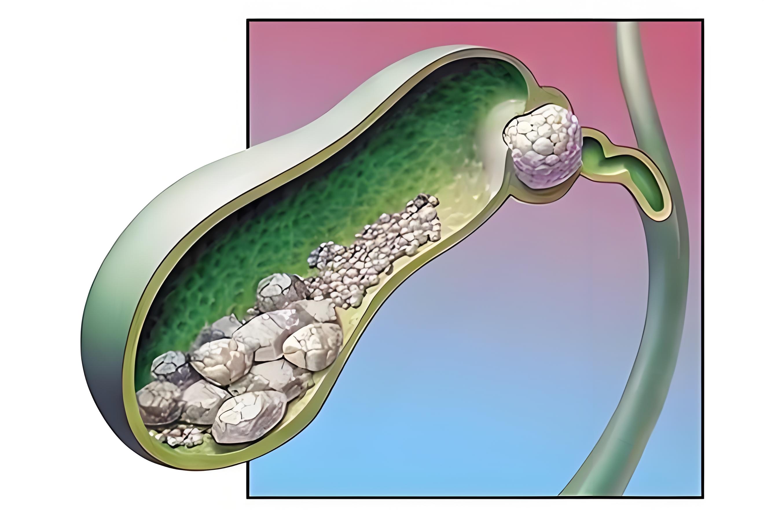 胆结石怎么引起的图片