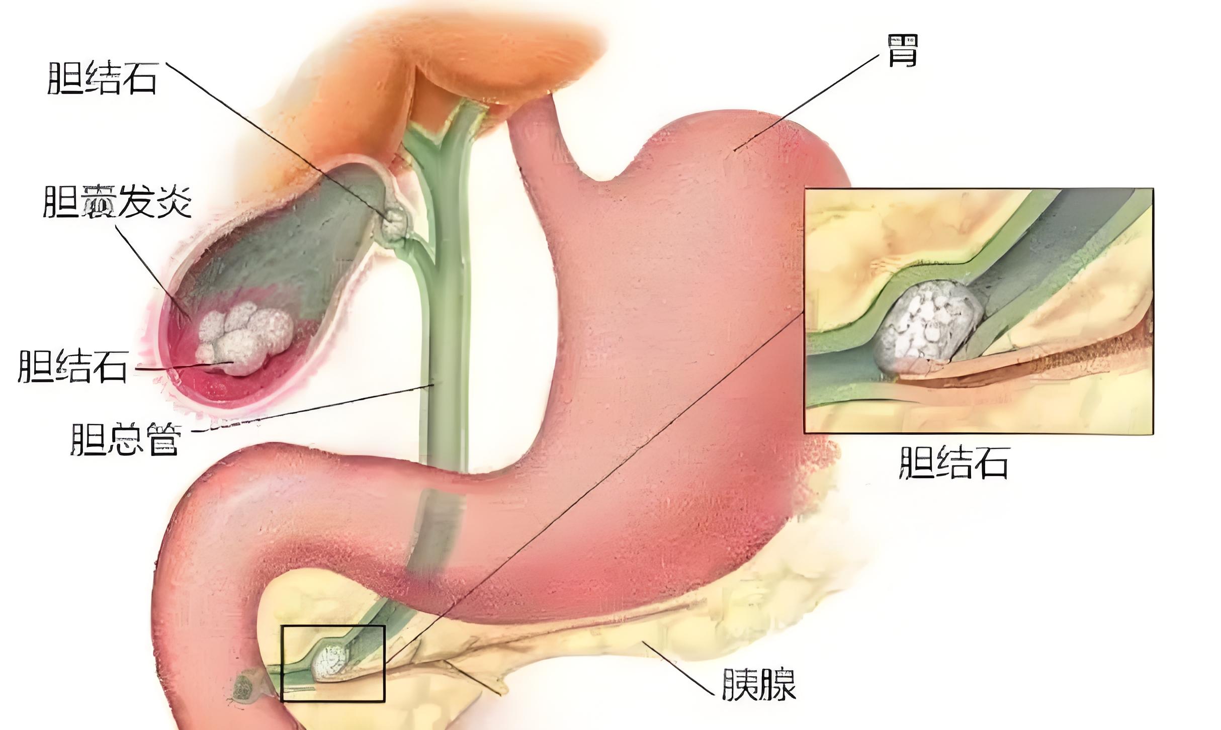 胆囊管结构图图片