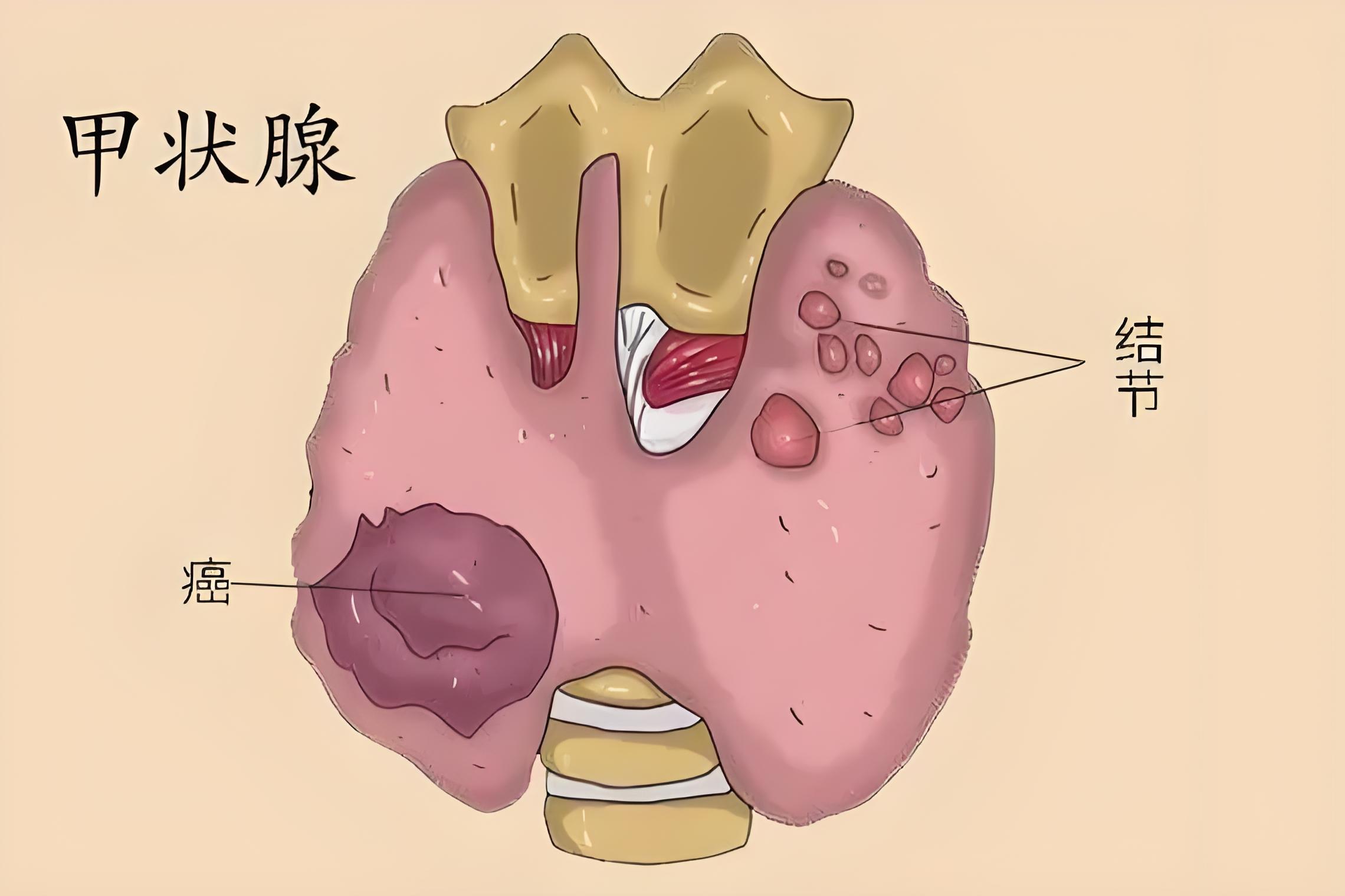 孕期甲状腺功能异常该怎么办