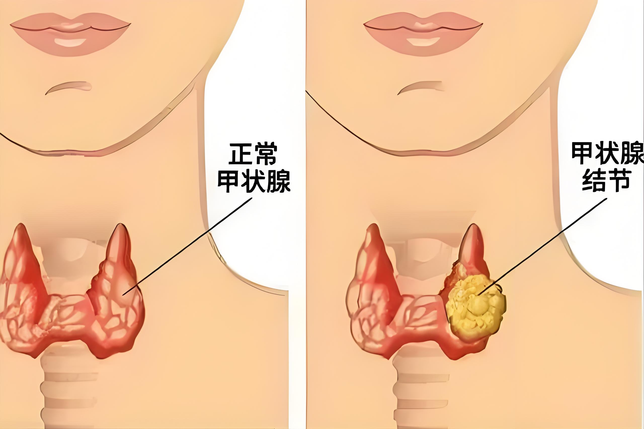 甲状腺4a小结节,别着急先观察调整