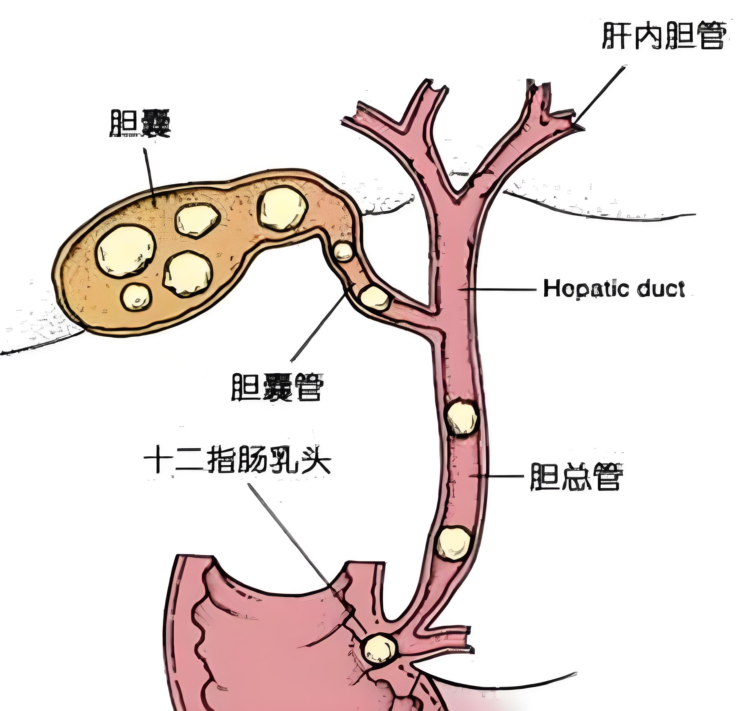 胆囊切与不切,应该如何抉择