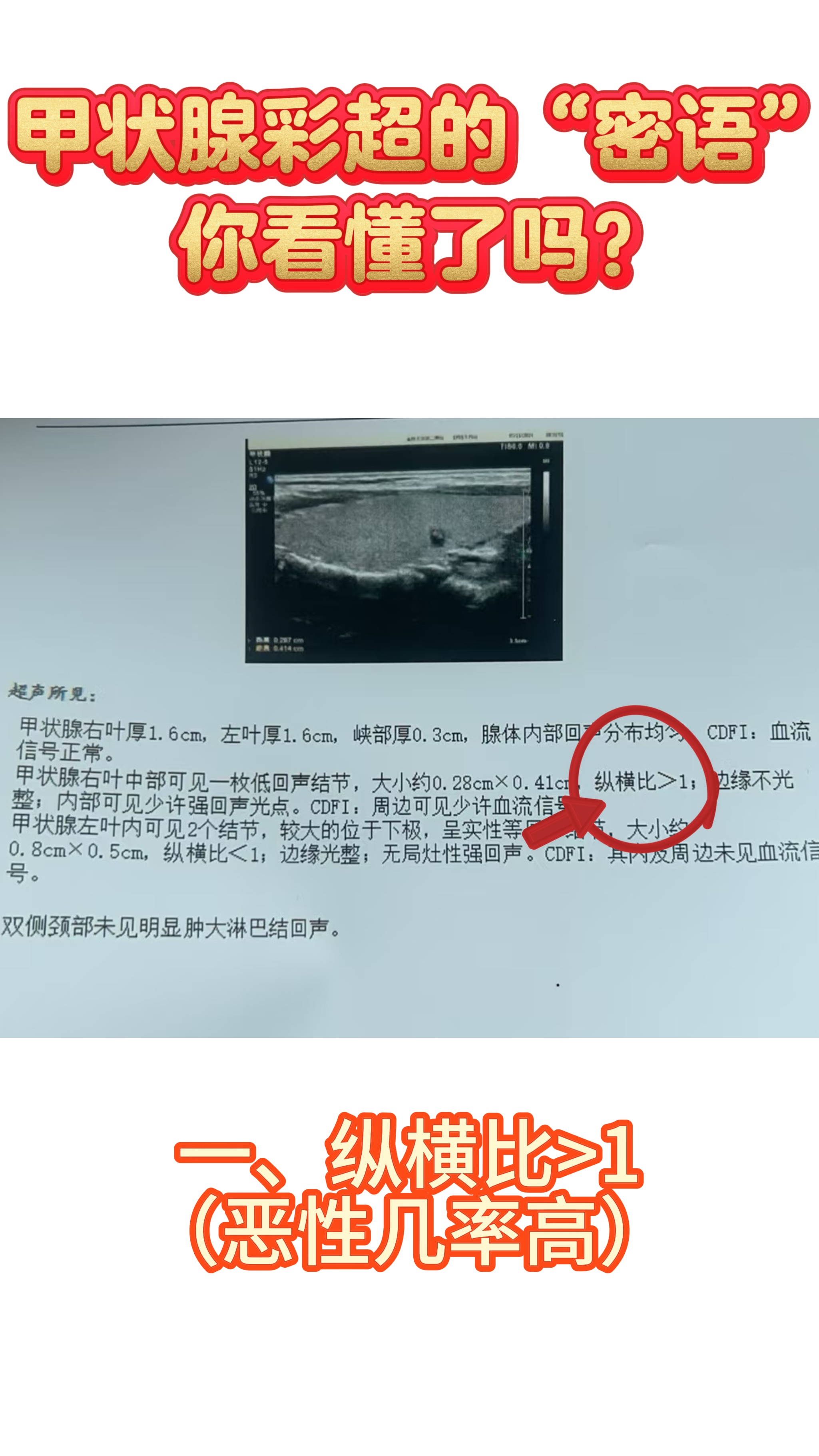 甲状腺彩超的"密语"你看懂了吗? #甲状腺