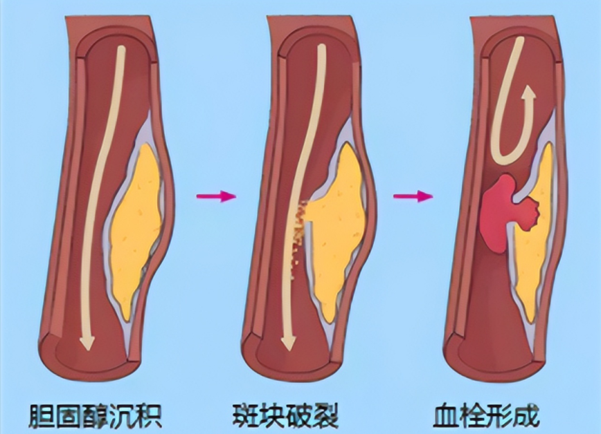 血管堵塞很大的原因是因为血管斑块,那为什么我们的血管会长斑块? ?