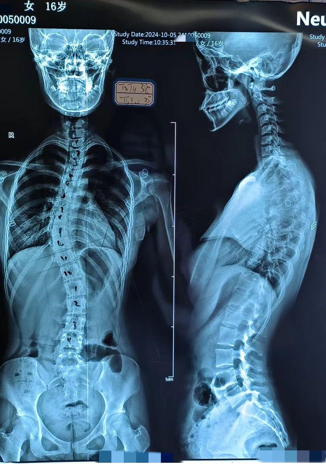 16岁女孩脊柱侧弯胸弯38度腰弯30度