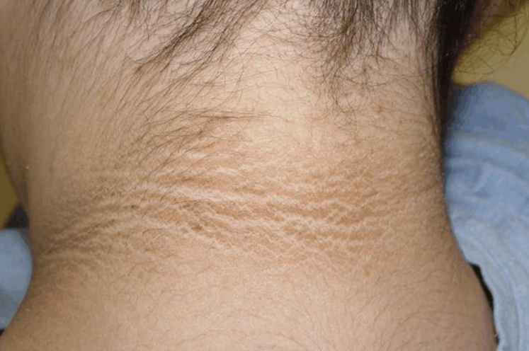 警惕"黑棘皮病":糖尿病的隐藏信号