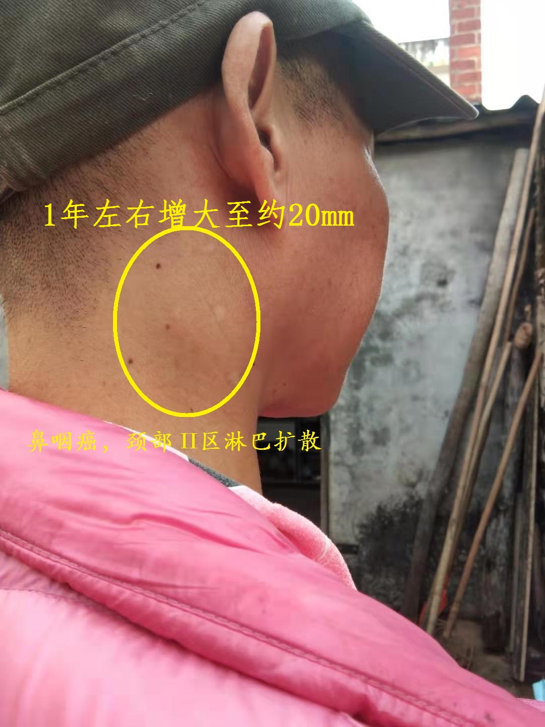 这是鼻咽癌4a期,广东癌,不是普通淋巴结肿大!