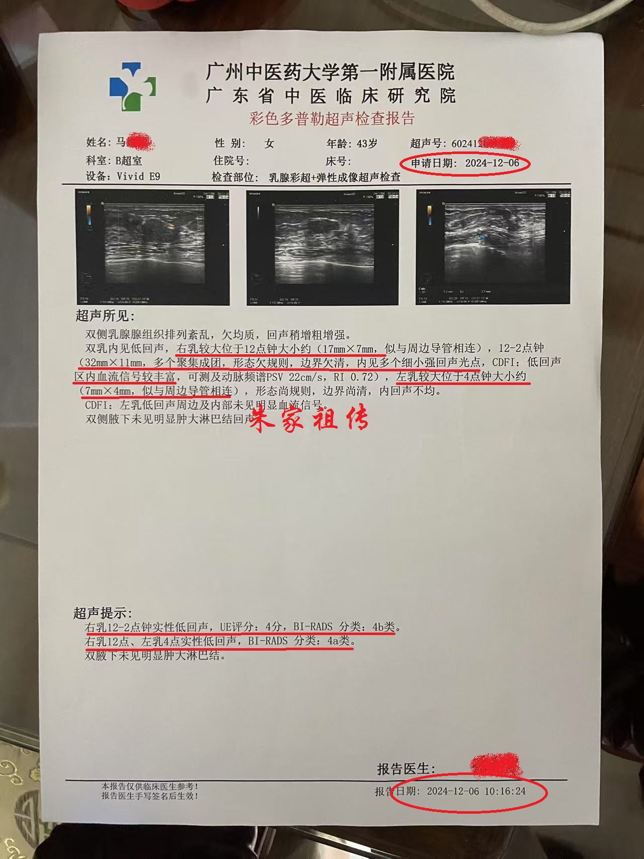 乳腺结节,从4b到4a了