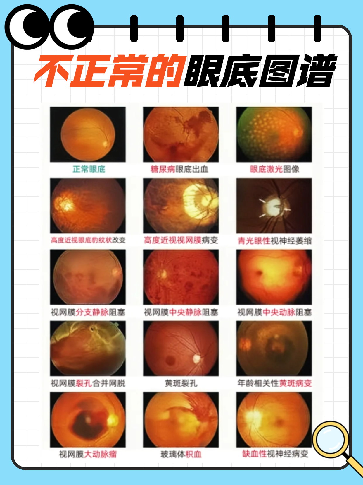 熊医生教你看不正常的眼底图谱!