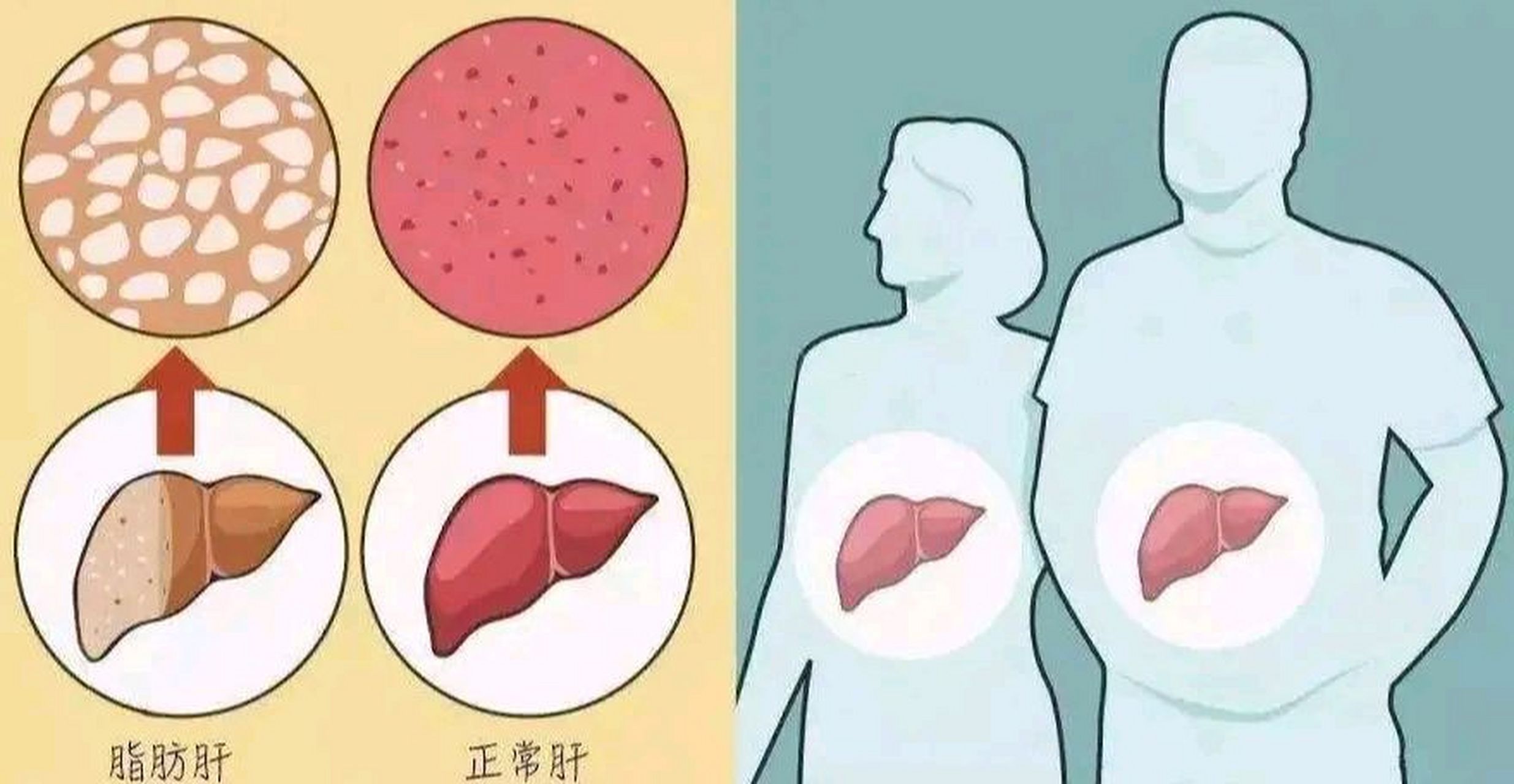 华氏108度.脂肪肝日常注意事项