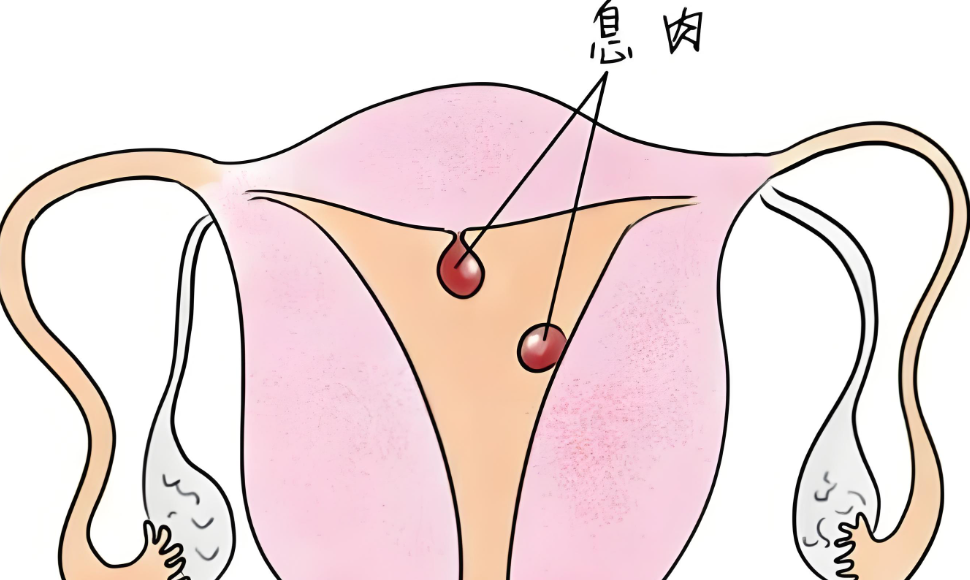 子宫内膜息肉症状图片