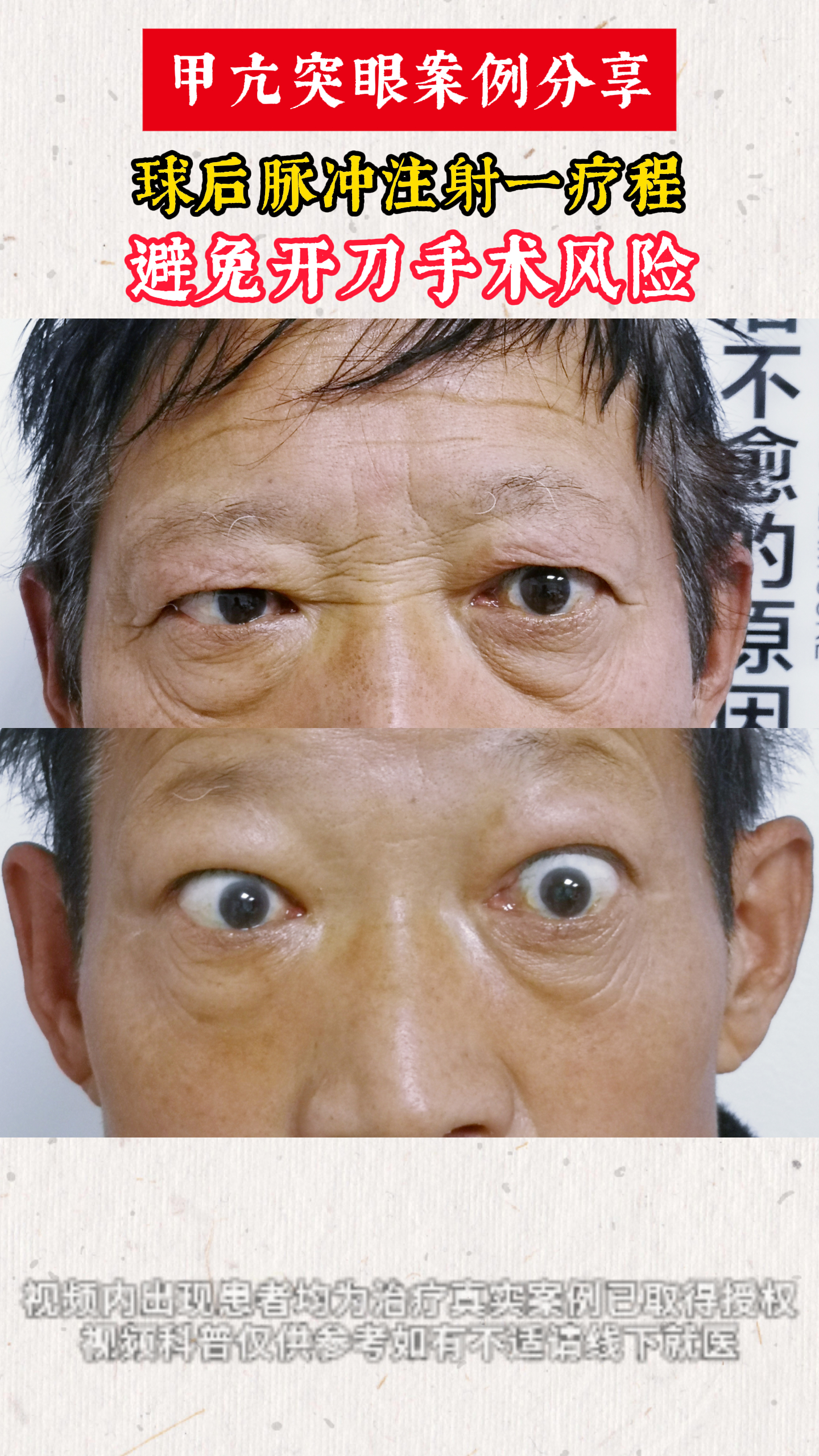 甲亢突眼案例分享
