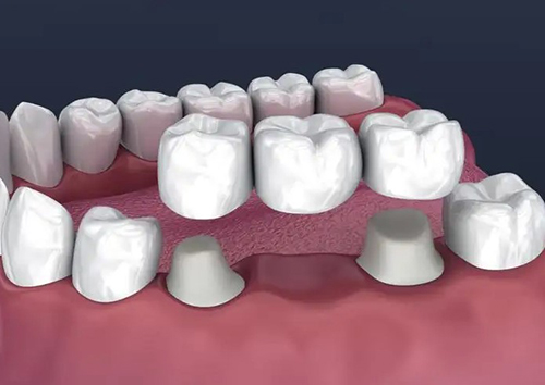 种植牙搭桥图片图片