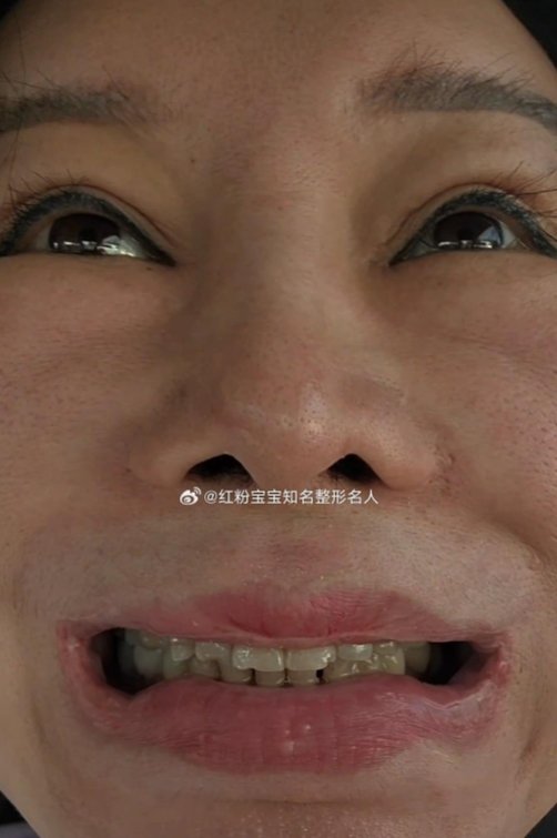 41岁红粉宝宝整容翻车!被嘲像80岁,崩溃卖300万房产继续整形