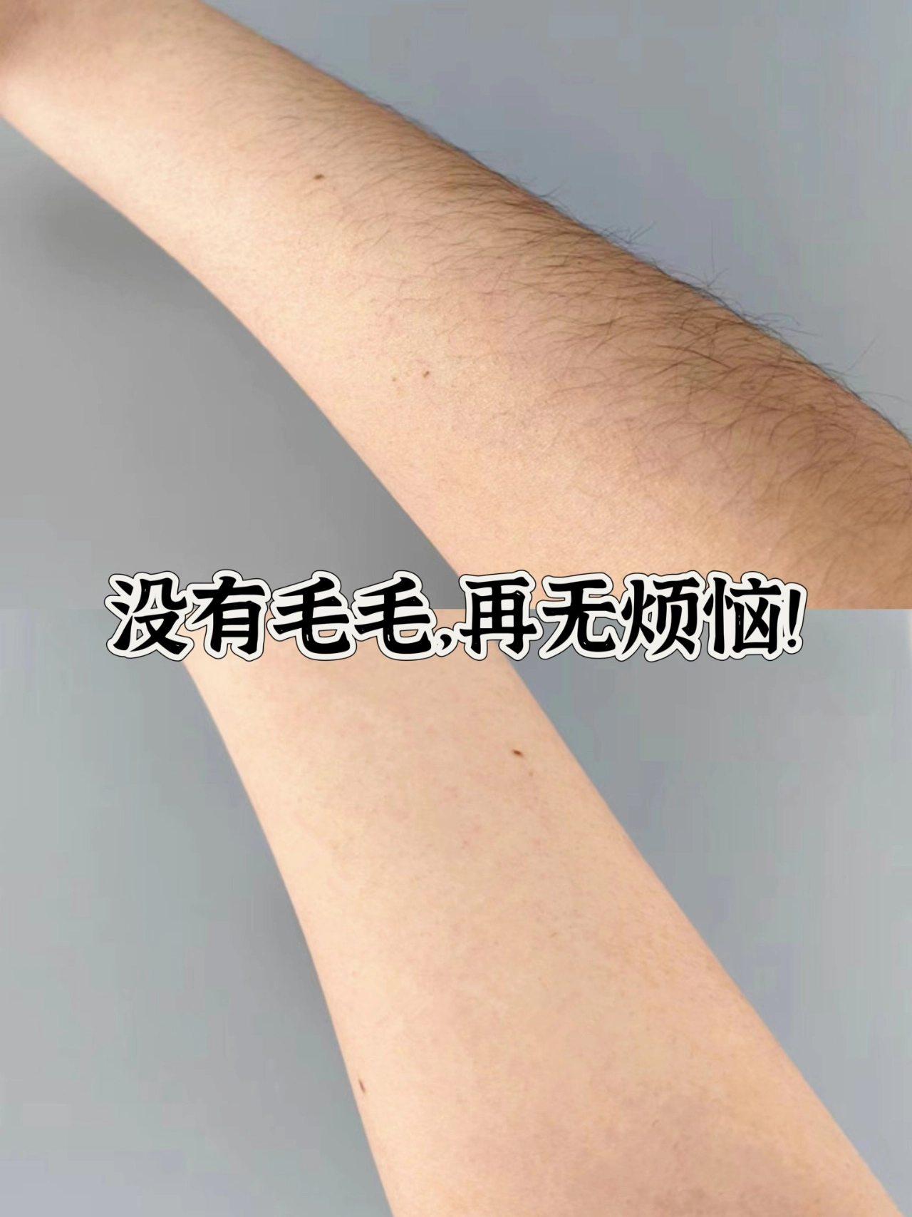 推荐类# 我的汗毛特别重两个胳膊上都是,真的让我很烦恼