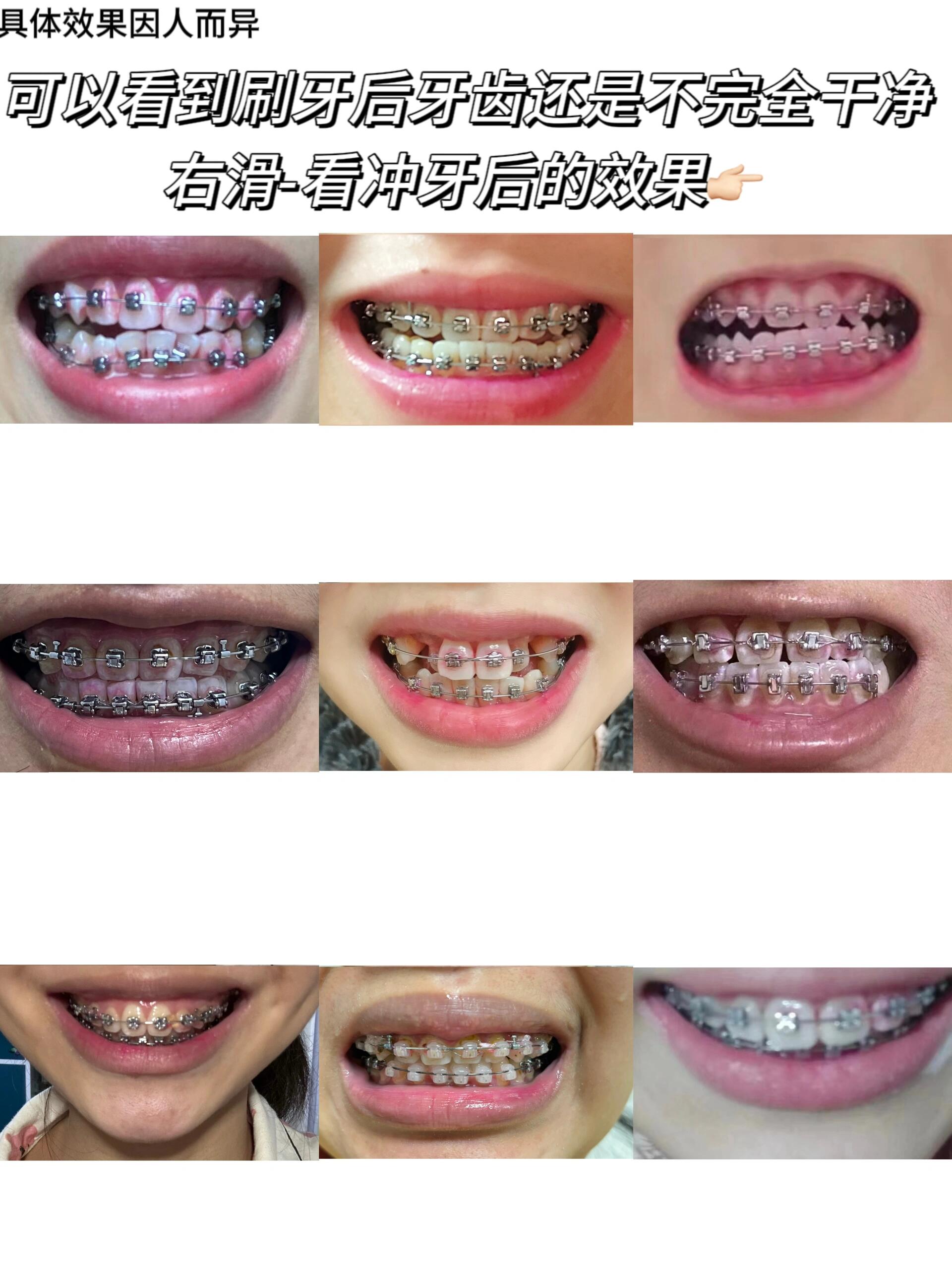 推荐类# 正畸两三年 摘下牙套喜提一口整齐的烂牙真不是吓唬人 特别