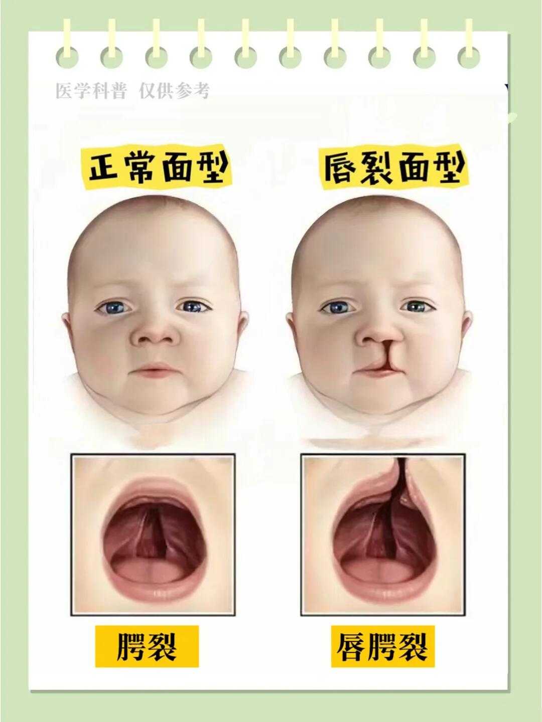 婴儿唇腭裂的修复方法