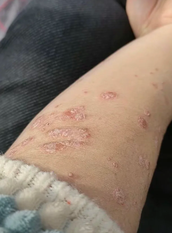 从不敢穿短袖到大胆露胳膊:牛皮癣治愈改变了我