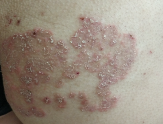 救命!谁懂屁股上长牛皮癣的痛啊!