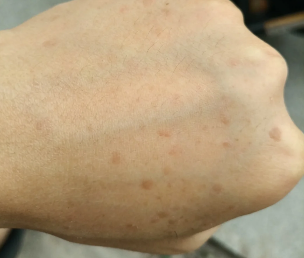 暑期兼职的意外烦恼:手背上的扁平疣成了心结