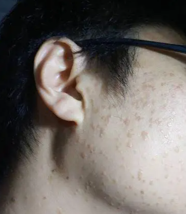 机械维修工手背扁平疣,操作不碍事
