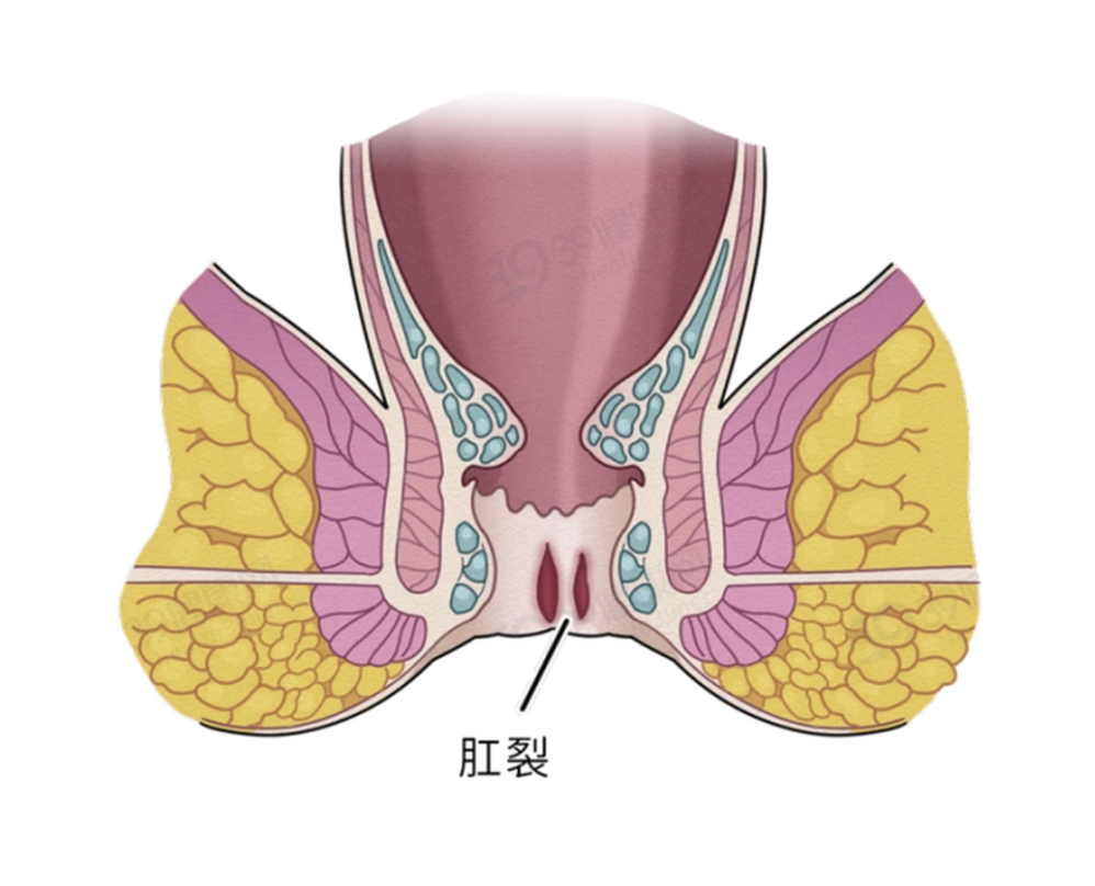 肛裂原因图片