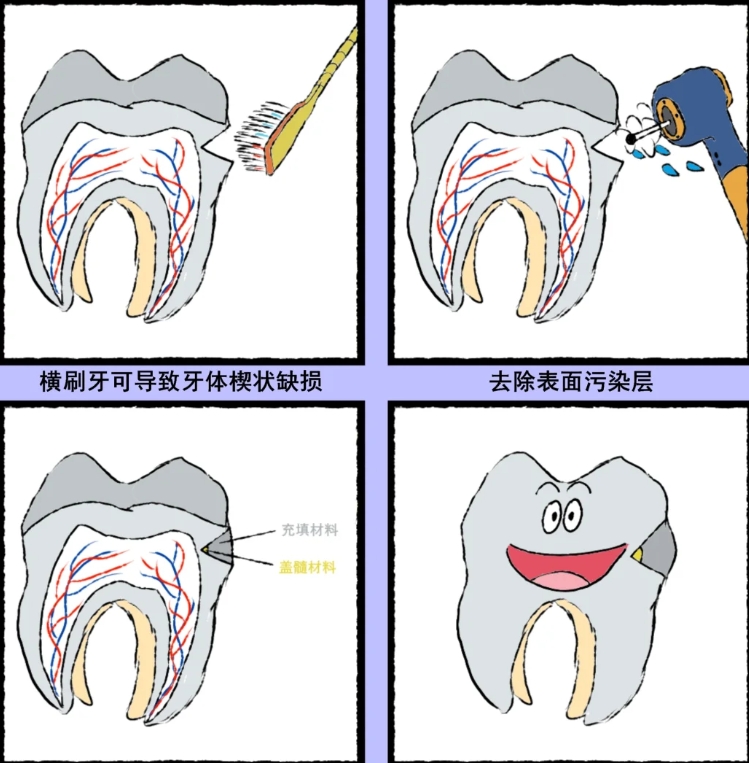 楔状缺损的原因图片