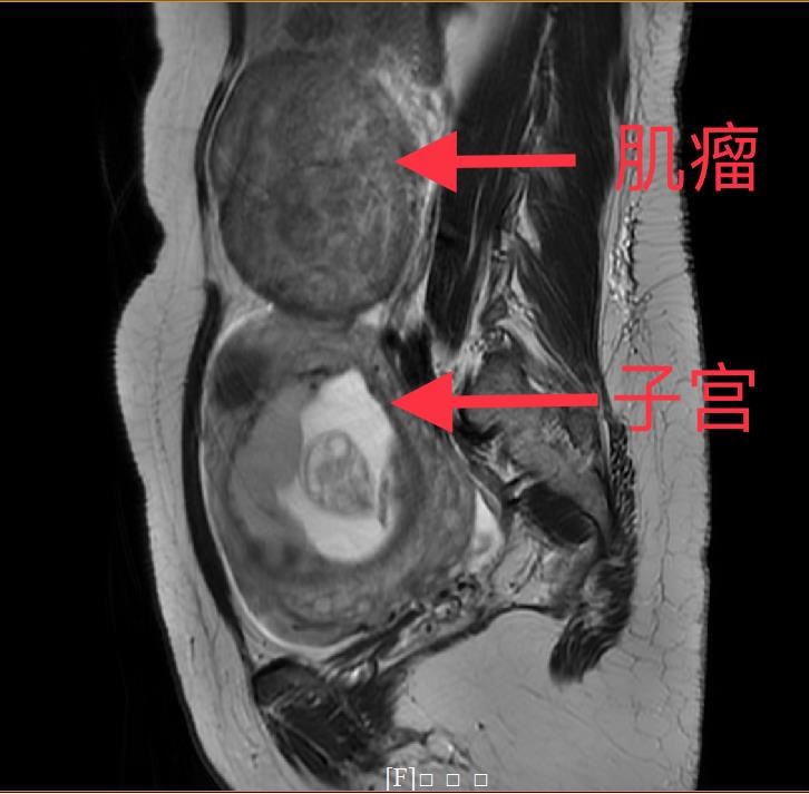 孕期子宫肌瘤激增至13厘米,南方医院多学科协作确保母婴安全