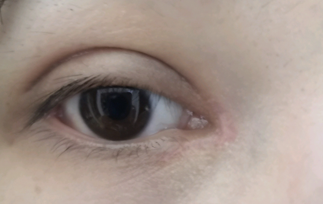 开眼角手术后疤痕增生如何消除