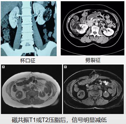 《肾脏错构瘤诊疗七问(文字版)》三:肾错构瘤需要做哪些检查?