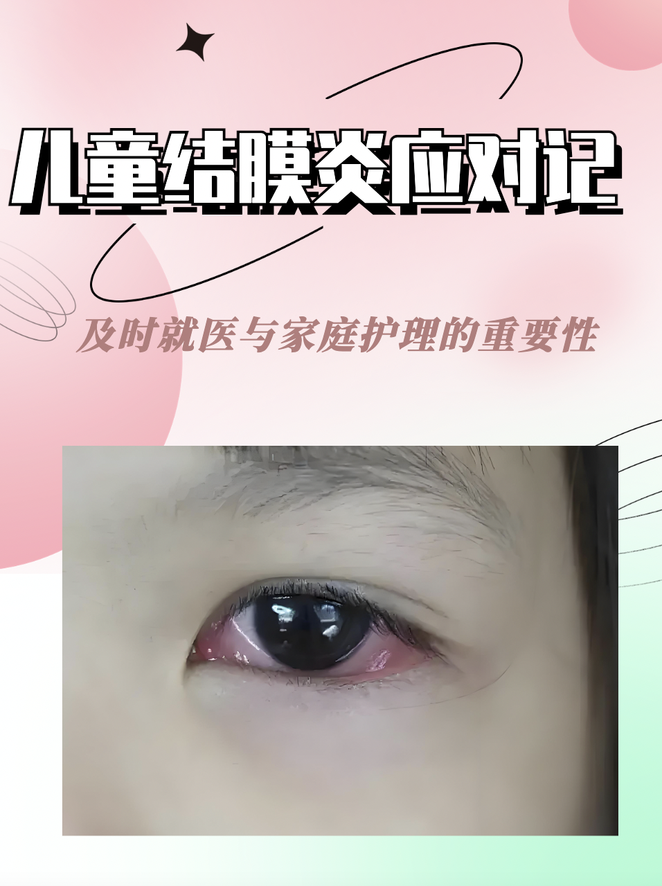儿童结膜炎应对记