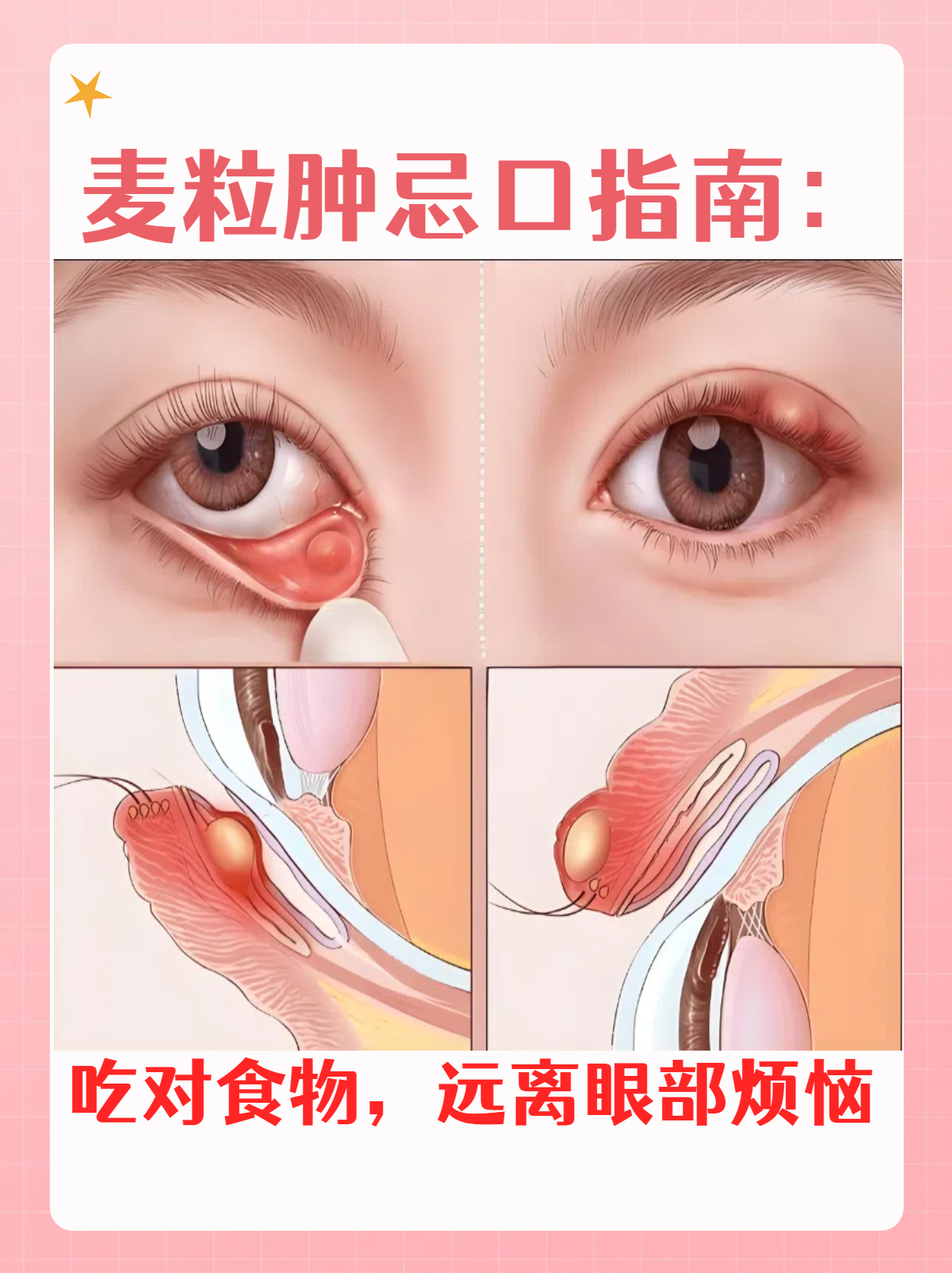 麦粒肿忌口指南:吃对食物,远离眼部烦恼