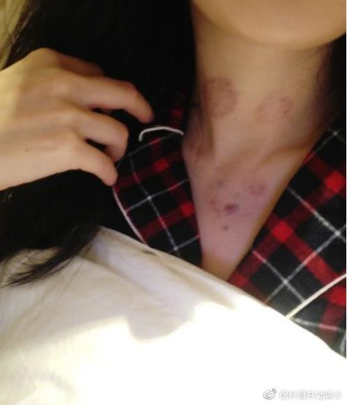 我看到女友脖子上的吻痕,可她从来不让我碰她脖子,她说唾液过敏