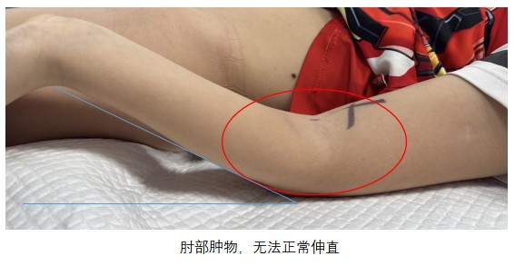 上肢肘部静脉畸形