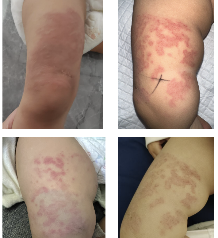 下肢丛状血管瘤介入治疗