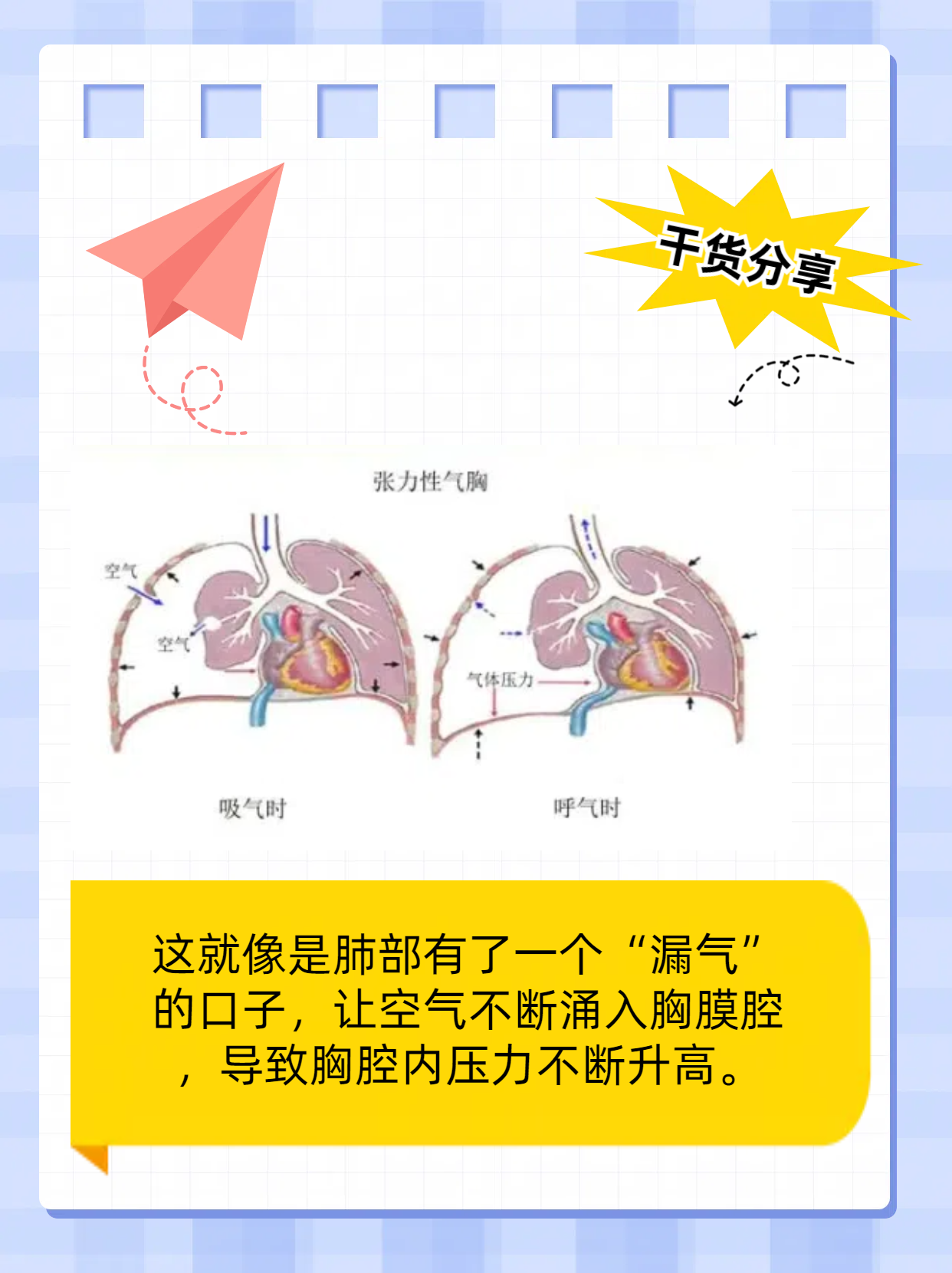 张力性气胸患者图片