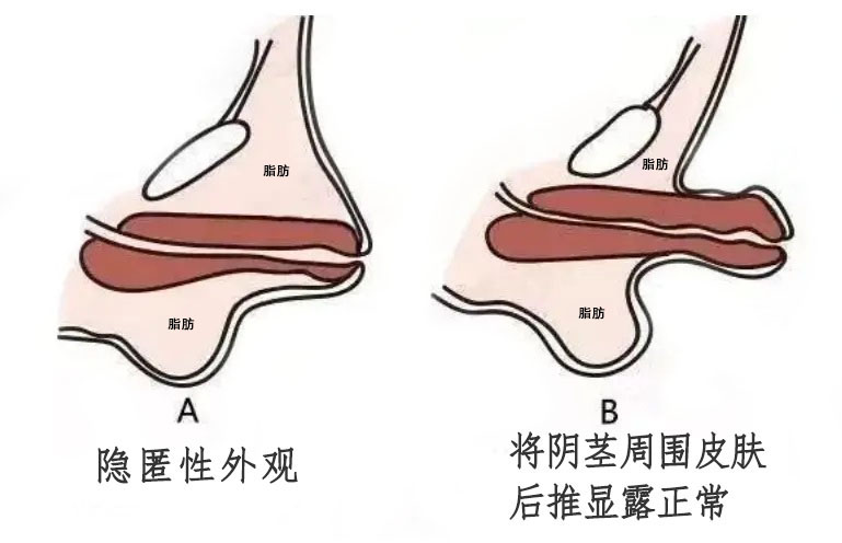 11岁鸡鸡不发育 1个方法教家长自测隐匿性阴茎