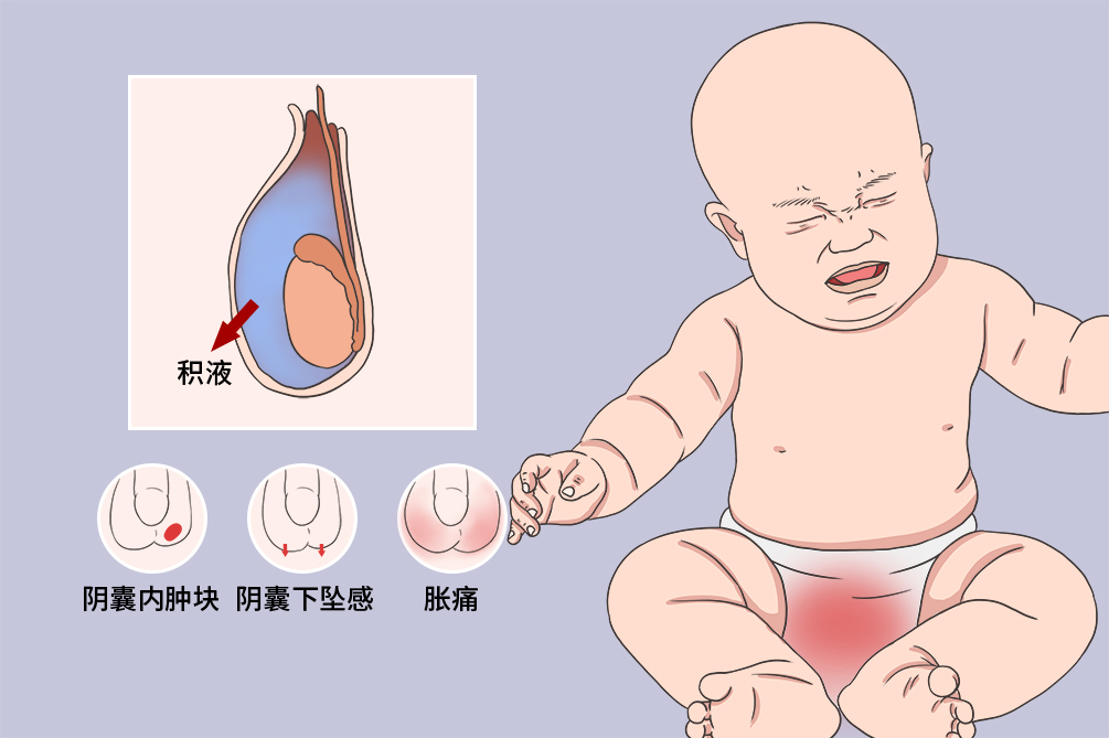 儿童鞘膜积液1岁后 建议直接手术