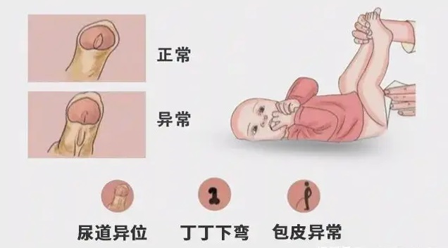 尿道下裂是母亲的原因图片