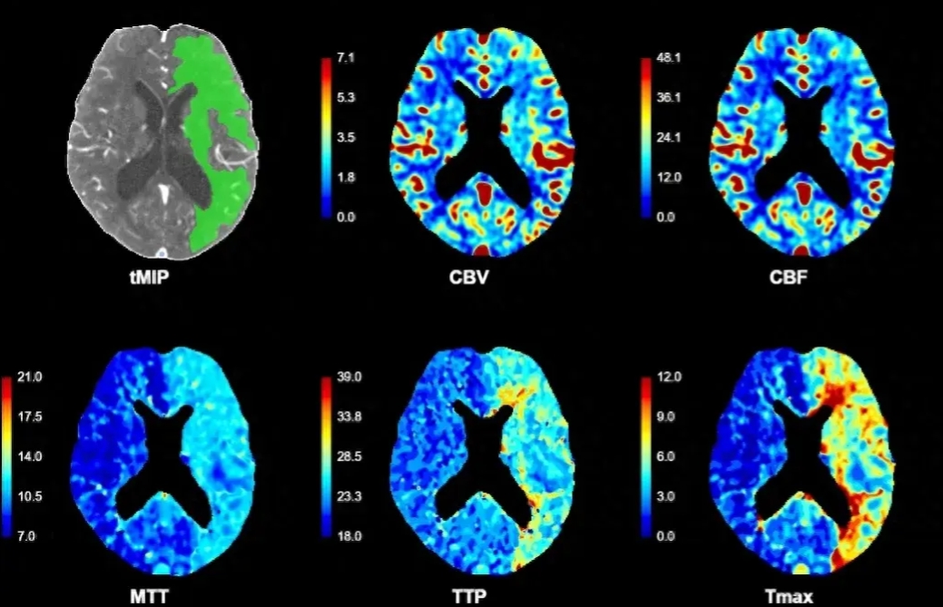 脑灌注成像颜色解读图片